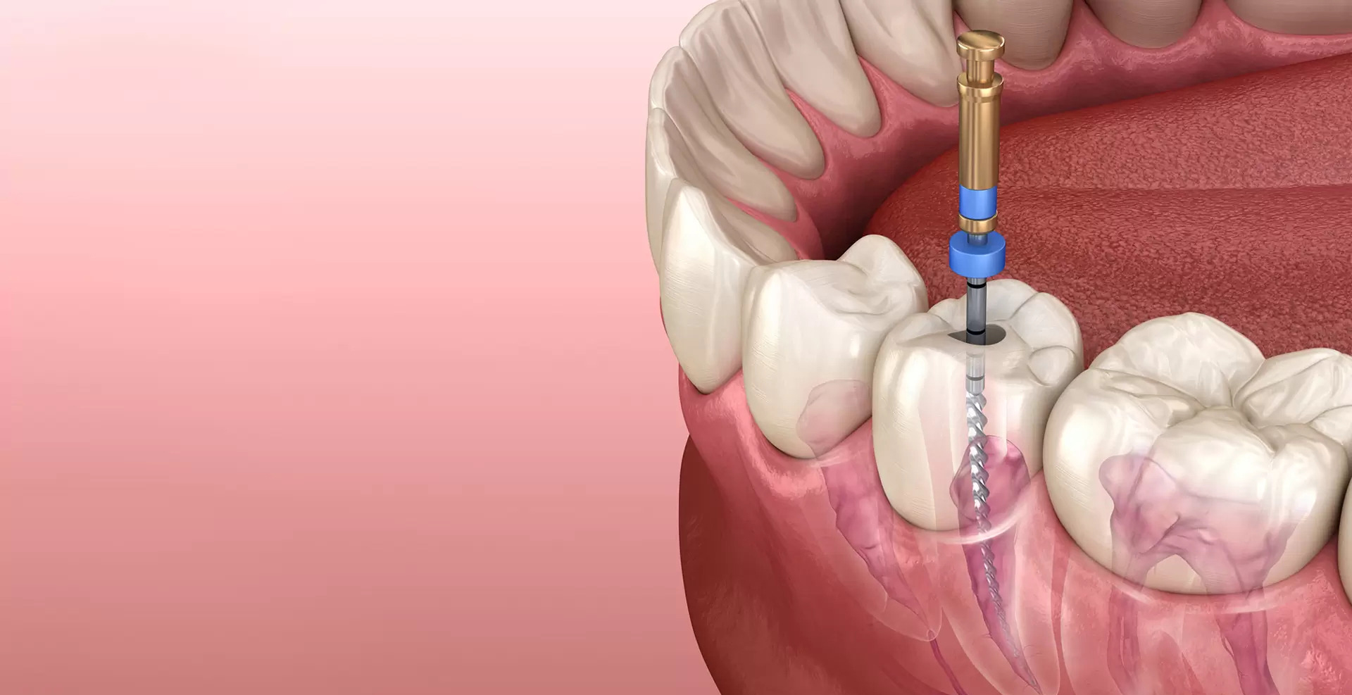 Root Canal Treatment